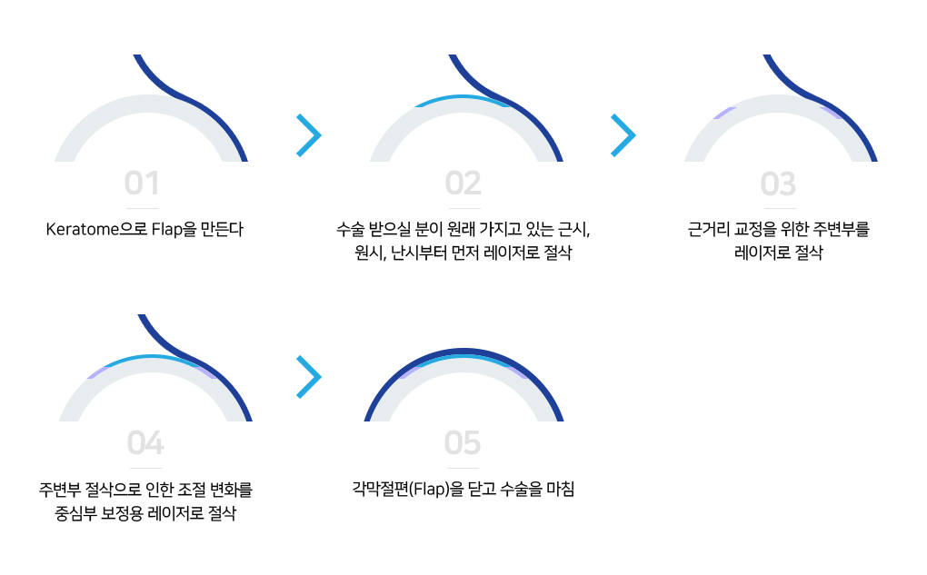 C-Near 노안교정 수술과정