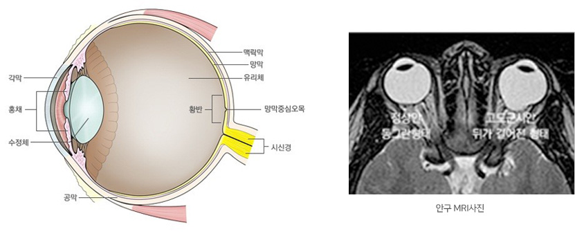 안구 MRI사진