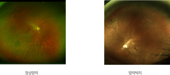 정상망막 망막박리