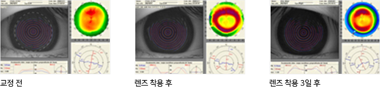 교정 전, 렌즈 착용 후, 렌즈 착용 3일 후