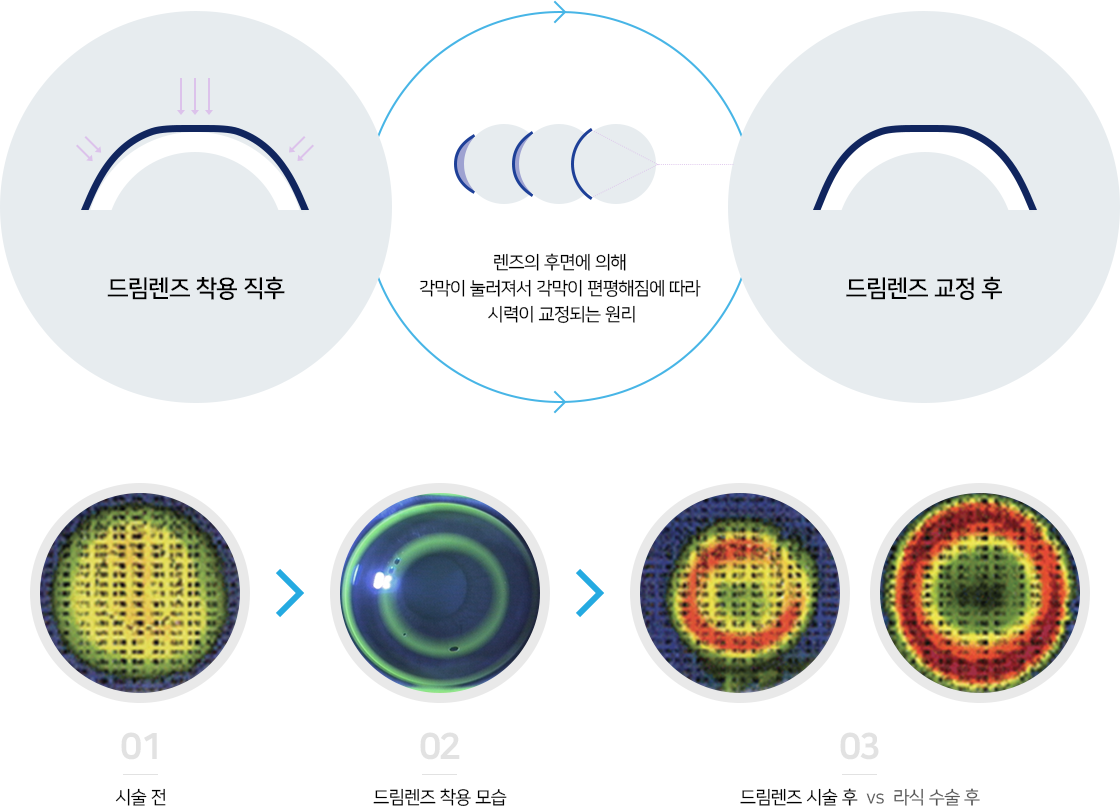 렌즈의 후면에 의해 각막이 눌러져서 각막이 편평해짐에 따라 시력이 교정되는 원리