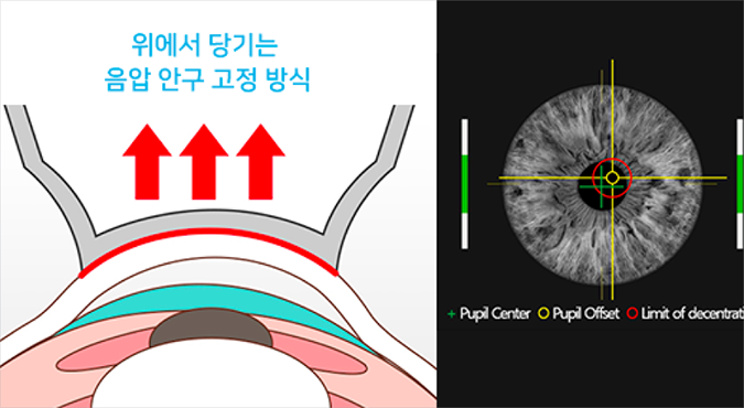 스마일라식 음압 고정 및 동공 정렬 화면