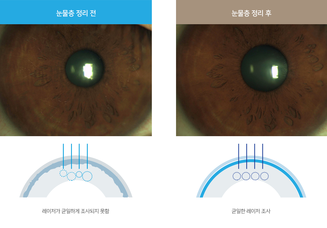 레이저가 균일하게 조사되지 못함, 균일한 레이저 조사