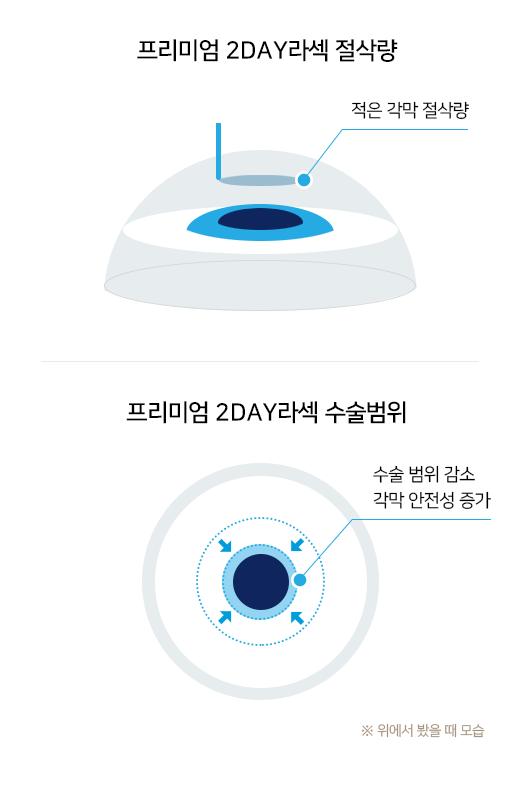 프리미엄 2DAY라섹 절삭량, 프리미엄 2DAY라섹 수술범위