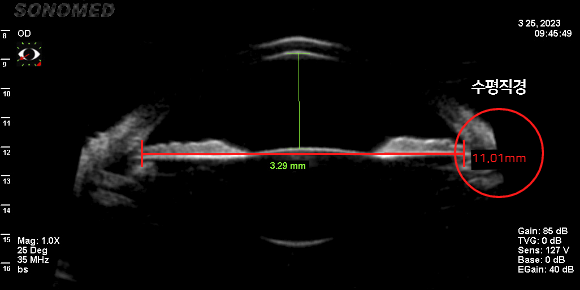 수평 안구 공간 측정 (11.01mm)