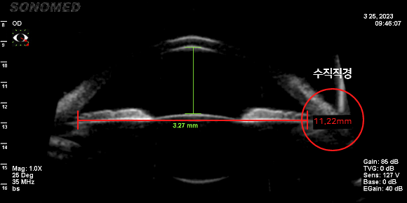 수평 안구 공간 측정 (11.01mm)