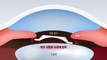 작은 렌즈를 삽입할 경우