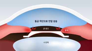 큰 렌즈를 삽입할 경우