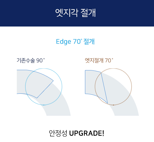 엣지각 절개
