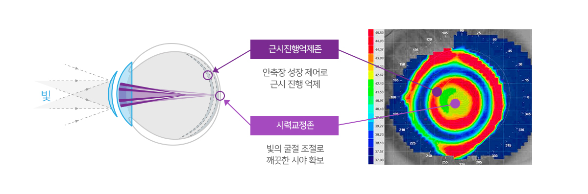 마이사이트의 시력교정 원리 이미지