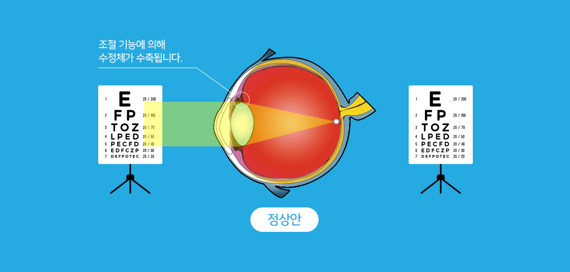 정상안 - 조절 기능에 의해 수정체가 수축됩니다.