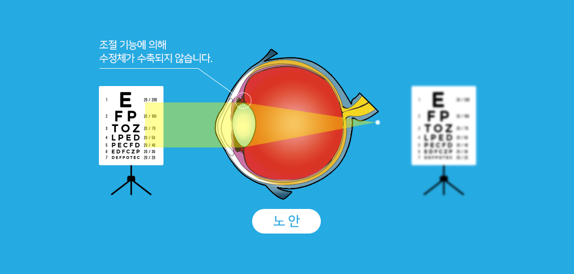 노안 - 조절 기능에 의해 수정체가 수축되지 않습니다.