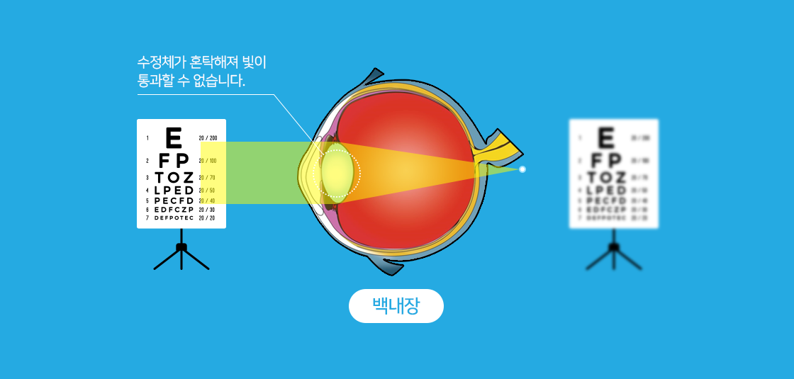 백내장 - 수정체가 혼탁해져 빛이 통과할 수 없습니다.