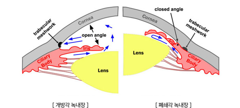 개방각 녹내장, 폐쇄각 녹내장