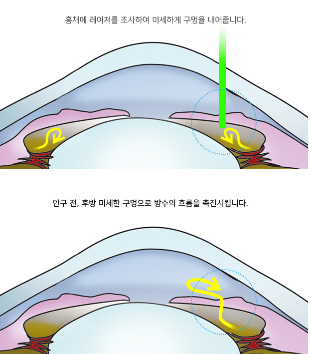 홍채에 레이저를 조사하여 미세하게 구멍을 내어줍니다. 안구 전, 후방 미세한 구멍으로 방수의 흐름을 촉진시킵니다.